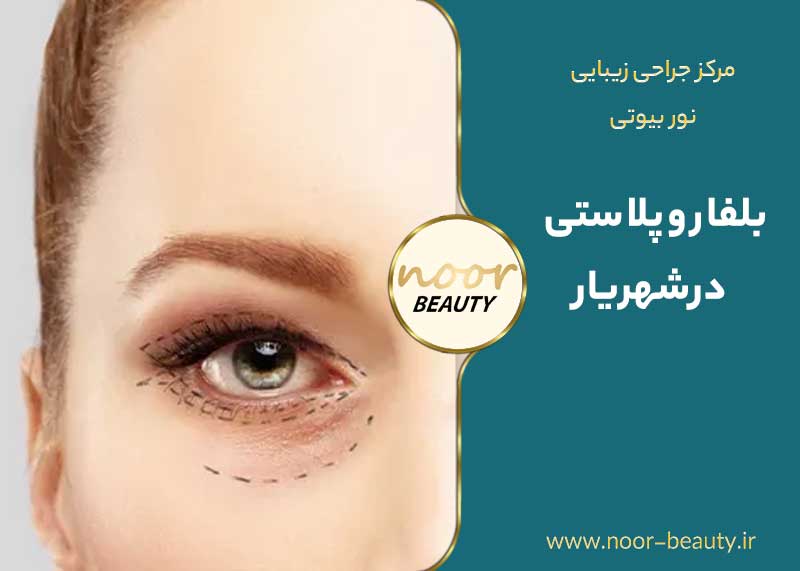 بلفاروپلاستی در شهریار