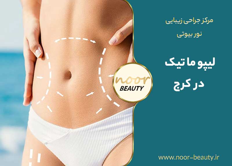 لیپوماتیک در کرج