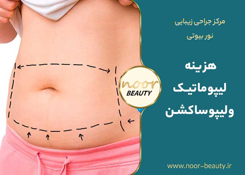 هزینه لیپوماتیک ولیپوساکشن